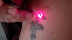 At home tattoo removal natural tattoo removal tattoo removal cost diy tattoo permanent custom reviews tattoo removal kit walmart where can i get a tattoo remov #tattooremoval. Laser Tattoo Removal Diy Home Made Laser No B S It Really Works Low Cost Youtube