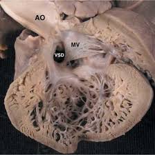 Image result for Left Ventricular Noncompaction
