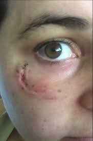 We did not find results for: Silicone Scar Sheets Before And After Pictures Silicone Sheets For Scars