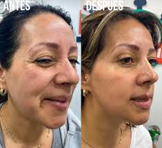 Top Non-Surgical Facial Treatments in Tijuana