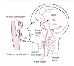 There are two large arteries in the neck, one on each side. Carotid Artery Disease Harvard Health