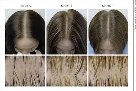 As far as i'm concerned, spironolactone is a miracle drug for female hair loss. Female Hair Loss Is Complicated Here Are 12 Proven Ways To Treat It