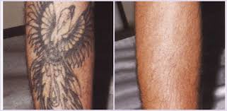 Maybe you would like to learn more about one of these? Artistic Tattoo And Permanent Makeup Removal Treatments Home Clinica Laser De Piel Especialistas En Laser De Piel Colombia