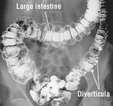 Image result for Diverticulitis