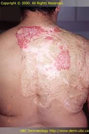 Image result for koebner phenomenon psoriasis
