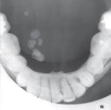 Image result for Sialolithiasis