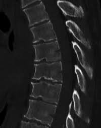 123rf.com.one particular type of kyphosis is. Scheuermann S Disease Wikipedia