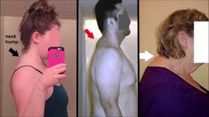Maybe you would like to learn more about one of these? How To Correct Neck Hump 3 Essential Steps By Posture Videos Medium