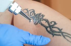 In this method of tattoo removal the tattoo is removed by broad spectrum light. Tattoo Removal Mi Laser Clinic Eastbourne England Uk