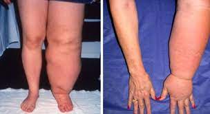 Lymphedema Causes Symptoms Therapy Diet Massage Exercises