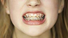 Orthodontia is pricey, and finding dental insurance that covers braces for adults can be challenging. 140 Metal Braces Ideas Metal Braces Braces Dental