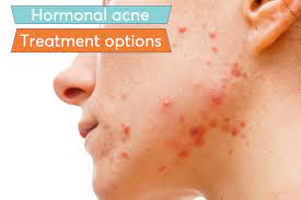 Birth control pills, also called oral contraceptives, are a hormonal therapy. Best Birth Control Pills For Women With Hormonal Acne Mdacne