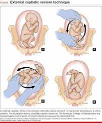 External Cephalic Version How To Increase The Chances For Success Mdedge Obgyn