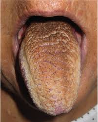 Image result for black hairy tongue symptoms