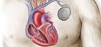Image result for Internal Cardiac Defibrillator