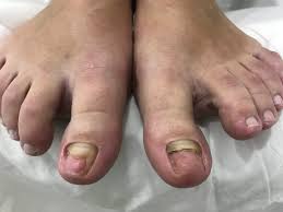 Ver más ideas sobre manicura de uñas, pintado de uñas cortas, uñas de gel bonitas. Problemas Mas Comunes En Las Unas De Los Pies La Vita Nails