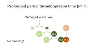 If an individual has isolated prolonged partial thromboplastin time, then the defect is in the intrinsic pathway. How To Interpret A Partial Thromboplastin Time Ptt Test Youtube