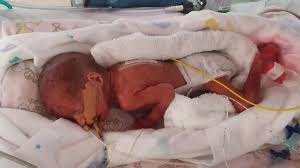 How big is your baby at 26 weeks pregnant? Dr Ted Weaver And Nurses And Midwives At Scuh Deliver 26 Week Baby Girl The Courier Mail