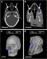 Image result for Sinus CT
