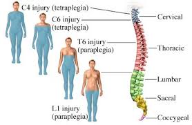 Image result for Spinal Trauma
