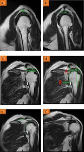 In 1986 bigliani et al. Assessment Of Acromial Morphology In Association With Rotator Cuff Tear Using Magnetic Resonance Imaging Sciencedirect