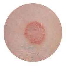 In both cases, untreated ringworm remains. Ringworm Not A Worm Not Always A Ring Still A Big Problem Updated For 2021 Pests Org