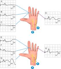 Joining of two tubular structures in order to direct the flow from one structure into the other. Plos One Morphological And Neurophysiological Impairment Of The Nerve In Type Ii Macrodactyly