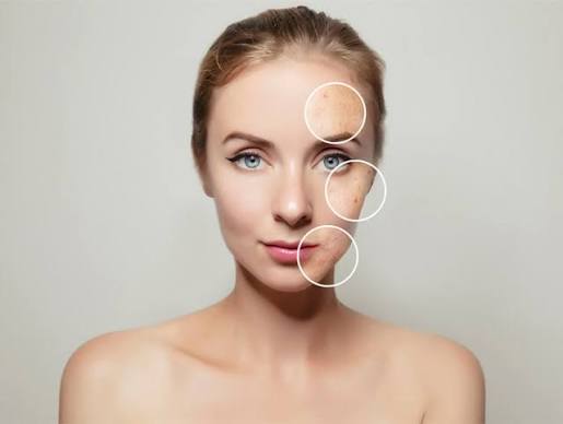 5 Different Types of Skin Blemishes on The Face And Its Treatments – SkinKraft