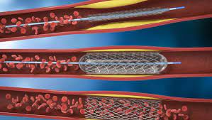 Véritable problème de santé publique, le cholestérol concernerait plus de 20 % de la population adulte française. Angioplastie Stents Deroulement Risques Et Convalescence