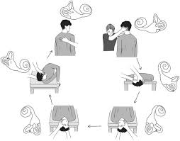 Image result for Canalith Repositioning Procedure