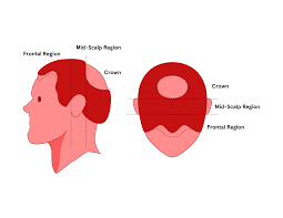 For example, endometriosis is a common condition that may create sporadic, sharp pain in the pelvic area that may radiate to the lower right back. The 4 Regions Of The Scalp Keeps