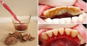 I am stuck at home in quarantine, and i want my mouth feeling so fresh and so clean clean, but i cannot schedule a dental cleaning right now. How To Remove Calculus From Teeth Without Going To The Dentist Teethwalls