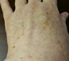 Image result for liver spots on legs