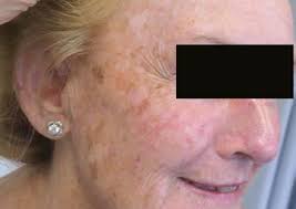 Role of volumetric modulated arc therapy in skin field cancerisation