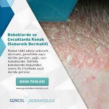 guncel dermatoloji en twitter bebeklerde ve cocuklarda konak seboreik dermatit konak tibbi adiyla seboreik dermatit genellikle sacli deride gorulen yagli sari kabuklardir siklikla bebeklerde dogumdan sonra ilk 6 haftada sacli deride gorulur