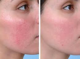 Pin En Rosacea Laser Treatment