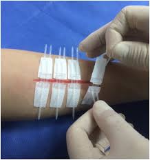 Non Invasive Closure Device 2 Clip Box Of 10 Packs