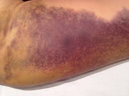 Bruising After Liposuction Lymphatic Drainage Helping Swelling And Bruising Heal The Natural Way Lymphatic Drainage Liposuction Lymphatic