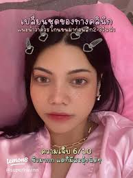 รีวิวเลเซอร์น้องสาวแบบ Hollywood: ประสบการณ์จาก deluna clinic