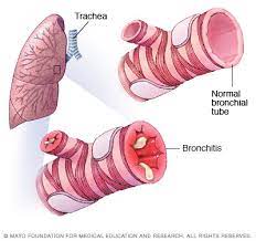 Facts about the most common cancer symptoms and signs, which include lumps, blood in stool or urine, nonhealing sores, unexplained weight loss, fever, swollen what are 18 signs and symptoms of cancer? Pulmonary Conditions We Treat Mankato Mayo Clinic Health System