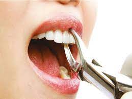 Causes For Tooth Extraction Dental Extraction Tooth Extraction Wisdom Teeth