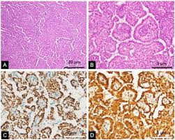 Primary ovarian mesothelioma is a rare, aggressive neoplastic disease with a poor prognosis. Peritoneal Well Differentiated Papillary Mesothelioma Coexisting With Endometrial Adenocarcinoma Mimicking Peritoneal Carcinomatosis A Case Report Sciencedirect