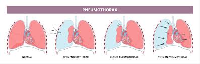 Image result for Pneumothorax