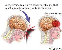 Concussion is also known as mild brain injury, mild traumatic brain injury, mild head injury, and minor head trauma. Concussion Medlineplus Medical Encyclopedia
