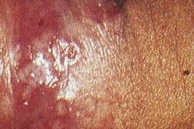 It is simple to puzzle herpes lesions with ingrown hair or effects of shaving around the genital areas. Genital Herpes Signs And Symptoms