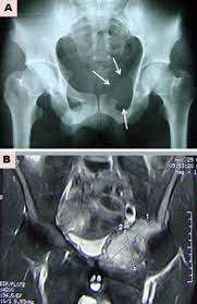 Less than 1 percent of all cancers is bone cancer and for this reason, it is considered to be rare. Https Ispub Com Ijos 15 1 7450