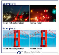 Mar 07, 2019 · people in the thread who had not been diagnosed with astigmatism reported that they too saw lights at night in the same smeary way: Astigmatism Q A With Dr Boyle Advanced Family Eye Care