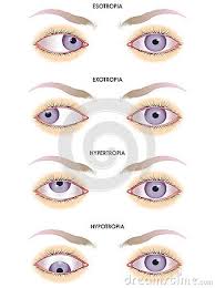 Strabismus Stock Image Image 28300621 Eye Anatomy Optometry Education Optometry School
