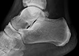 Image result for Ankle XRay