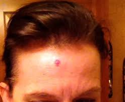 The most common site of blood vessel proliferation is in the face. We Get Old Deal With It You Re My Favorite Today